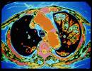 ACE Inhibitors, ARBs Slow Progression of Emphysema ACE Inhibitors, ARBs Slow Progression of Emphysema
