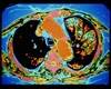 ACE Inhibitors, ARBs Slow Progression of Emphysema ACE Inhibitors, ARBs Slow Progression of Emphysema