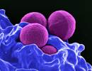 Choosing the Right Antibiotic in Cystic Fibrosis Using the Sputum Microbiome Choosing the Right Antibiotic in Cystic Fibrosis Using the Sputum Microbiome