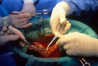 DAAs improved the survival of patients undergoing liver transplantation for HCV-related liver disease. DAAs improved the survival of patients undergoing liver transplantation for HCV-related liver disease.