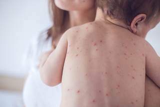 All cases were suggested to have derived from a single importation of measles virus genotype D4. All cases were suggested to have derived from a single importation of measles virus genotype D4.