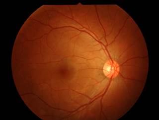 Unilateral white cataracts were seen in 7.4% of Ebola virus disease survivors. Unilateral white cataracts were seen in 7.4% of Ebola virus disease survivors.