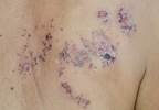 Robust Immune Responses for Herpes Zoster Subunit Vaccine Robust Immune Responses for Herpes Zoster Subunit Vaccine
