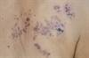 Herpes Zoster Risk May Increase With Common Rheumatoid Arthritis Drugs Herpes Zoster Risk May Increase With Common Rheumatoid Arthritis Drugs