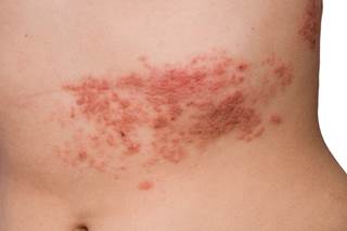 Two doses of herpes zoster subunit vaccine were found to substantially reduce the overall risk of complications in adults 50 years of age and older. Two doses of herpes zoster subunit vaccine were found to substantially reduce the overall risk of complications in adults 50 years of age and older.
