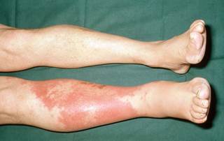 Clindamycin unlikely to benefit in invasive group A streptococci infections. <i>Credit: Clinical Photography, Central Manchester University Hospitals NHS Foundation Trust, UK/Science Source. </i> Clindamycin unlikely to benefit in invasive group A streptococci infections. <i>Credit: Clinical Photography, Central Manchester University Hospitals NHS Foundation Trust, UK/Science Source. </i>