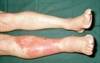 No Benefits Seen for Adjunctive Clindamycin in Cellulitis No Benefits Seen for Adjunctive Clindamycin in Cellulitis