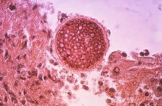 The majority of patients from non-endemic states had traveled to a coccidioidomycosis-endemic area. The majority of patients from non-endemic states had traveled to a coccidioidomycosis-endemic area.
