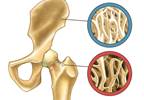 Bone Density at the Hip Declines Twice as Fast in HIV-Infected Women Bone Density at the Hip Declines Twice as Fast in HIV-Infected Women