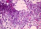 Relapse-Free Cure From MDR-TB Higher Than Anticipated Relapse-Free Cure From MDR-TB Higher Than Anticipated
