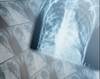 Azithromycin Prevents COPD Exacerbations in <i>H pylori</i> Seropositive Patients Azithromycin Prevents COPD Exacerbations in <i>H pylori</i> Seropositive Patients