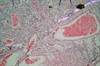 HIV Status May Not Effect Incidence of Invasive Cervical Cancer HIV Status May Not Effect Incidence of Invasive Cervical Cancer