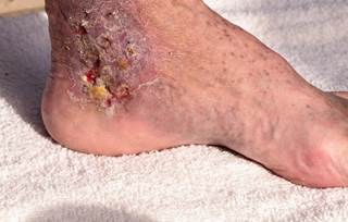 The researchers found that antibiotic prophylaxis correlated with reduced risk of recurrence compared with no treatment or placebo. The researchers found that antibiotic prophylaxis correlated with reduced risk of recurrence compared with no treatment or placebo.
