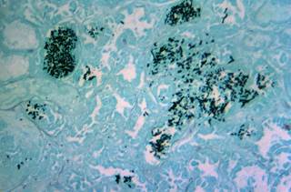 The T2 Candida Panel detects 5 species of Candida: <i>C albicans, C tropicalis, C parapsilosis, C krusei, and C glabrata. Photo Credit: CDC/Dr Hicklin.</i> The T2 Candida Panel detects 5 species of Candida: <i>C albicans, C tropicalis, C parapsilosis, C krusei, and C glabrata. Photo Credit: CDC/Dr Hicklin.</i>