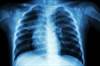 Whole Genome Sequencing Use in Predicting TB Resistance Whole Genome Sequencing Use in Predicting TB Resistance