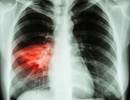 Procalcitonin Diagnostic Algorithm Useful in Bacterial Pneumonia Procalcitonin Diagnostic Algorithm Useful in Bacterial Pneumonia