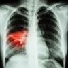 Procalcitonin Diagnostic Algorithm Useful in Bacterial Pneumonia Procalcitonin Diagnostic Algorithm Useful in Bacterial Pneumonia