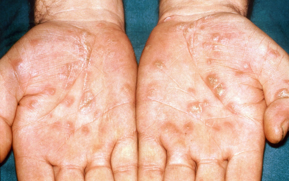 skin-diseases-remain-common-in-older-adults-with-hiv