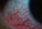 Conjunctivitis More Common in Adult Women Than Men Conjunctivitis More Common in Adult Women Than Men
