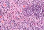 Treating ABSSSI in Diabetes: Efficacy of Dalbavancin Examined Treating ABSSSI in Diabetes: Efficacy of Dalbavancin Examined