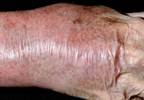 Dalbavancin Safe and Effective for ABSSSI in Patients With SIRS Dalbavancin Safe and Effective for ABSSSI in Patients With SIRS