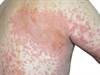 Skin Pathology Commonly Associated With HIV Infection Skin Pathology Commonly Associated With HIV Infection