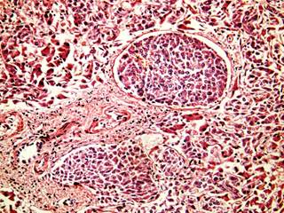 Sustained virological response correlated to a significantly lower risk of liver cancer in multivariable models no matter the type of antiviral treatment. Sustained virological response correlated to a significantly lower risk of liver cancer in multivariable models no matter the type of antiviral treatment.