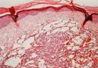 Checkpoint Blockade Demonstrates Antitumor Activity in HIV-Associated Kaposi Sarcoma Checkpoint Blockade Demonstrates Antitumor Activity in HIV-Associated Kaposi Sarcoma