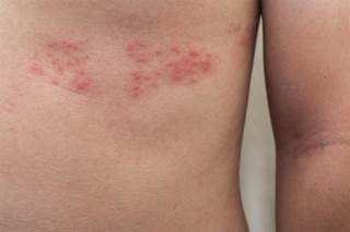 Rheumatoid arthritis was significantly associated with the development of herpes zoster in this cohort. Rheumatoid arthritis was significantly associated with the development of herpes zoster in this cohort.