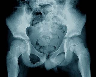 The most common month of symptom onset was July. <i>Photo Credit: ISM/SOVEREIGN.</i> The most common month of symptom onset was July. <i>Photo Credit: ISM/SOVEREIGN.</i>