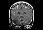 Challenges in Diagnosing Tuberculous Meningitis Challenges in Diagnosing Tuberculous Meningitis