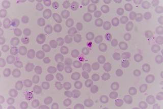 As well as malaria, they are also evaluating Artemisone for the treatment of human cytomegalovirus infections. As well as malaria, they are also evaluating Artemisone for the treatment of human cytomegalovirus infections.