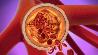 DPP-4 inhibition has the potential to reduce cardiovascular morbidity in treated HIV infection. DPP-4 inhibition has the potential to reduce cardiovascular morbidity in treated HIV infection.