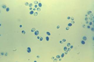 Urinalysis should be performed routinely when late-onset sepsis is suspected in preterm neonates. <i>Photo Credit: CDC/Dr Lucille K. Georg</i>. Urinalysis should be performed routinely when late-onset sepsis is suspected in preterm neonates. <i>Photo Credit: CDC/Dr Lucille K. Georg</i>.