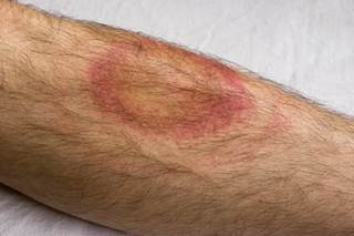 Both Canada's Public Health Agency and the CDC recommend a 2-tiered testing process for a patient with suspected Lyme disease. Both Canada's Public Health Agency and the CDC recommend a 2-tiered testing process for a patient with suspected Lyme disease.