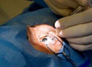 Cataract-related claims account for about 60% of eye care charges in Medicare population in the US. Cataract-related claims account for about 60% of eye care charges in Medicare population in the US.