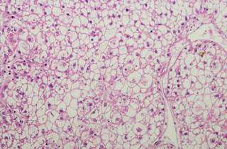 Risk of liver cancer was positively associated with increasing levels of HBV DNA and HBsAg in dose-response manners. Risk of liver cancer was positively associated with increasing levels of HBV DNA and HBsAg in dose-response manners.