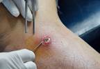 Trimethoprim-Sulfamethoxazole Effective Regardless of Abscess Size Trimethoprim-Sulfamethoxazole Effective Regardless of Abscess Size