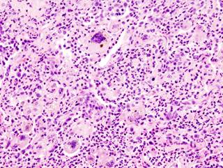 The magnitude of the association was similar for typical and atypical antipsychotics. <i>Photo Credit: Wikimedia Commons.</i> The magnitude of the association was similar for typical and atypical antipsychotics. <i>Photo Credit: Wikimedia Commons.</i>