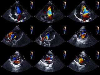 Current or former smoking status was associated with increased pulmonary artery systolic pressure in HIV-infected individuals. Current or former smoking status was associated with increased pulmonary artery systolic pressure in HIV-infected individuals.