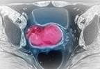 How HIV Affects Cervical Cancer Risk and Outcomes How HIV Affects Cervical Cancer Risk and Outcomes