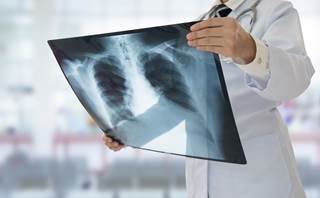 Community-acquired pneumonia is responsible for 20% of all deaths that occur in children age <5 years. Community-acquired pneumonia is responsible for 20% of all deaths that occur in children age <5 years.