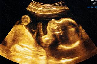 fetus in an ultrasound fetus in an ultrasound