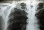 Update to Pulmonary Tuberculosis Screening Recommendations Update to Pulmonary Tuberculosis Screening Recommendations