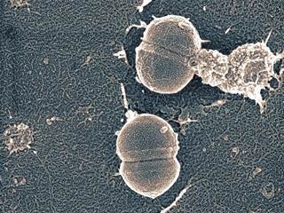 Long-term complications of group B streptococcus in infants include the potential for deafness and developmental disabilities. <i>Photo Credit: Dr Gary Gaugler/Science Source.</i> Long-term complications of group B streptococcus in infants include the potential for deafness and developmental disabilities. <i>Photo Credit: Dr Gary Gaugler/Science Source.</i>