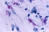 Safety of Clofazimine in Treating Children With <i>Mycobacterium abscessus</i> Infections Safety of Clofazimine in Treating Children With <i>Mycobacterium abscessus</i> Infections