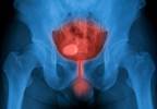 Machine Learning Methods Can Detect UTI in Dementia Patients Machine Learning Methods Can Detect UTI in Dementia Patients