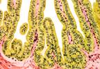 Helicobacter pylori Infection Linked to Gallbladder Diseases Helicobacter pylori Infection Linked to Gallbladder Diseases