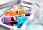 Simplifying Viral Hepatitis Testing Will Slow the Spread of Disease Simplifying Viral Hepatitis Testing Will Slow the Spread of Disease