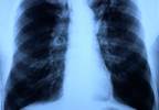 Decreased Tuberculosis Risk With Metformin vs Sulfonylureas Decreased Tuberculosis Risk With Metformin vs Sulfonylureas